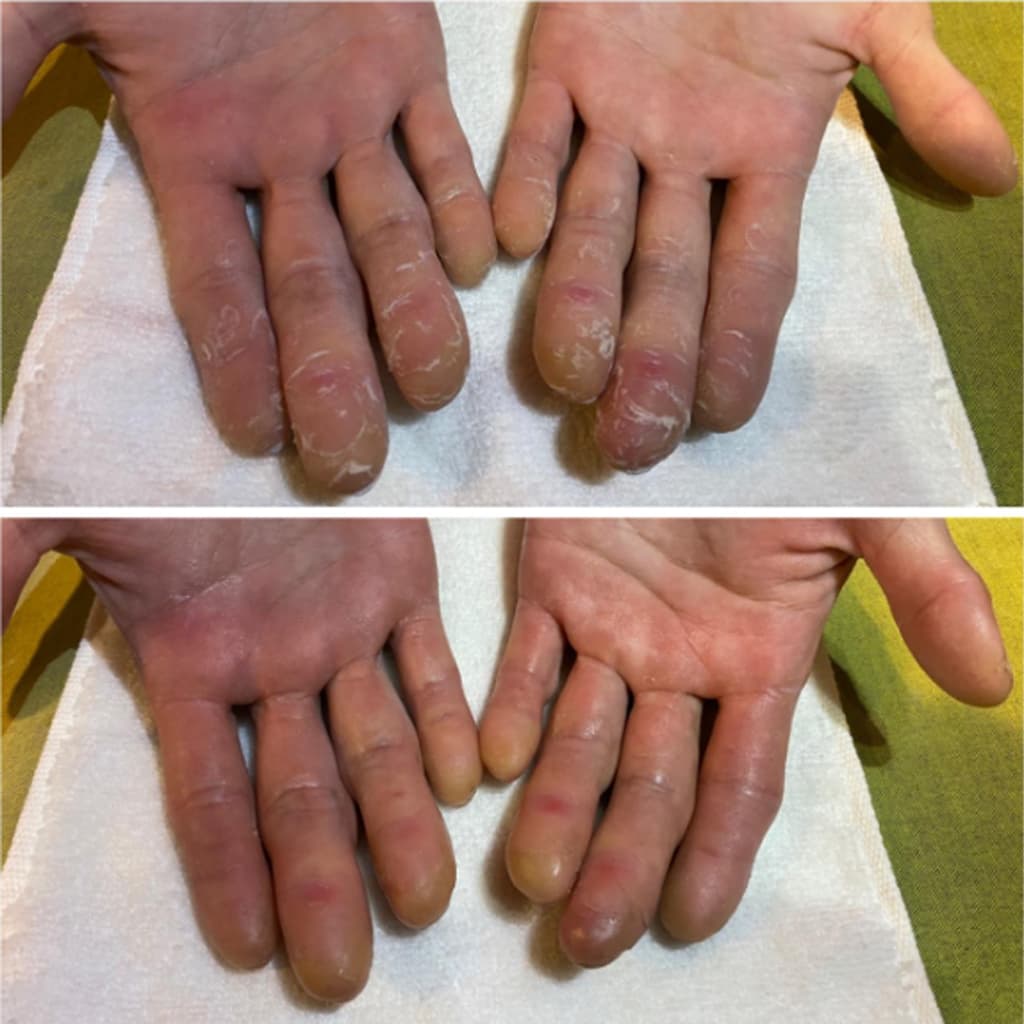 アスリートネイル変化例2